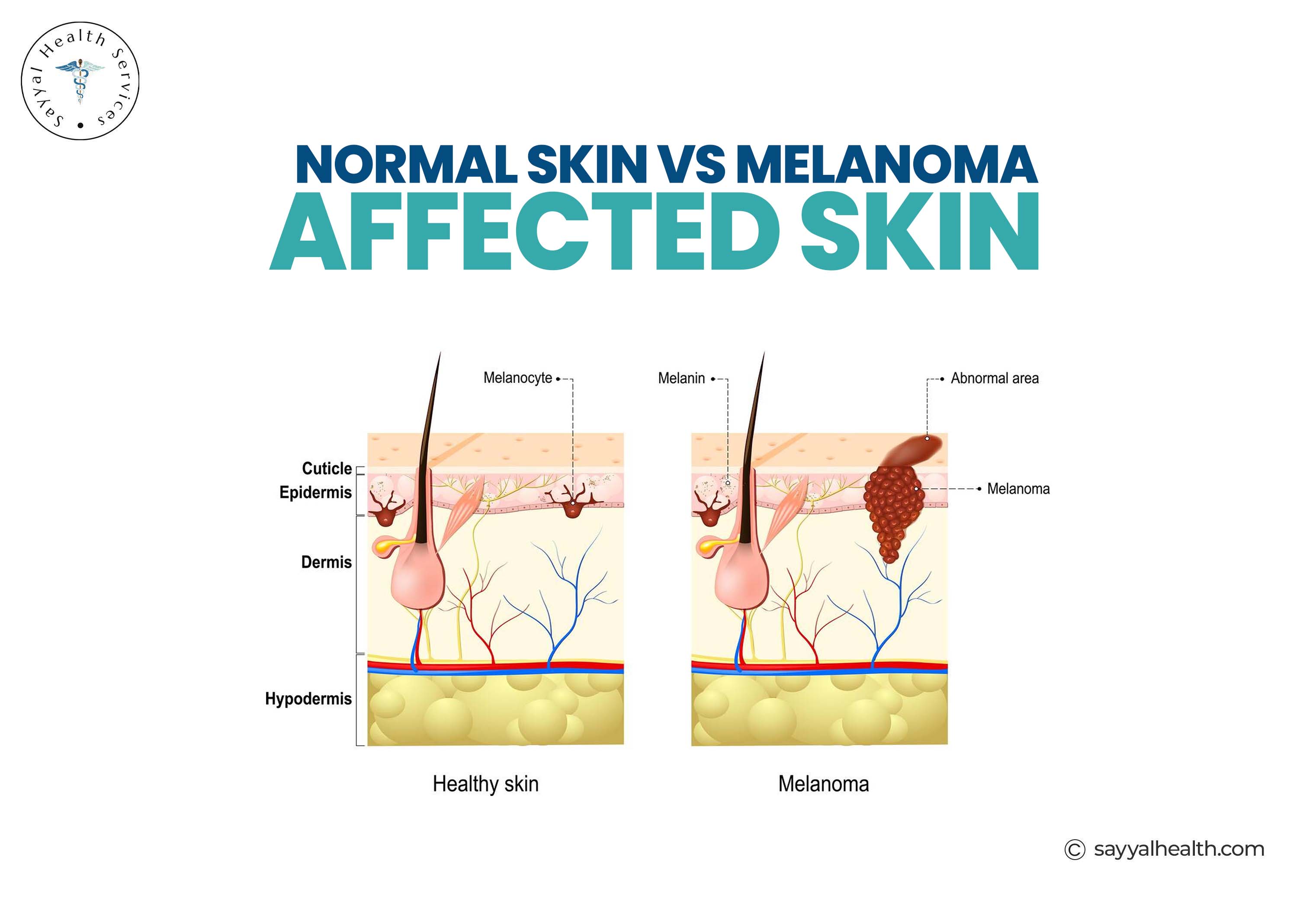 Normal skin vs melanoma skin layer diagram showing melanocyte differences